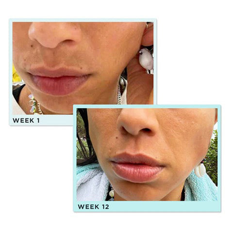 ZitSticka Before and After Melasma