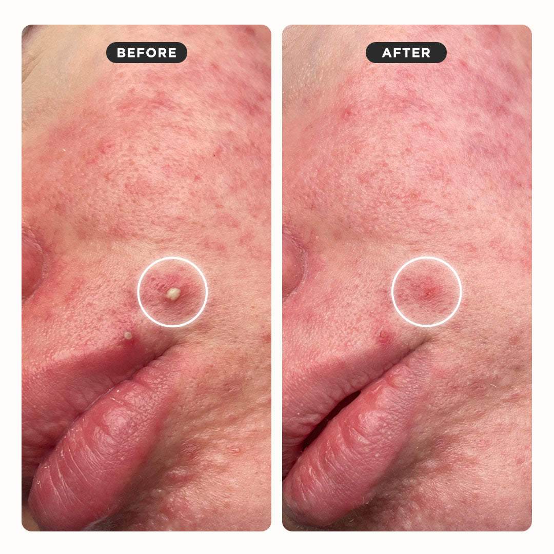 GOO GETTER™ Hydrocolloid Surface Pimple Patches