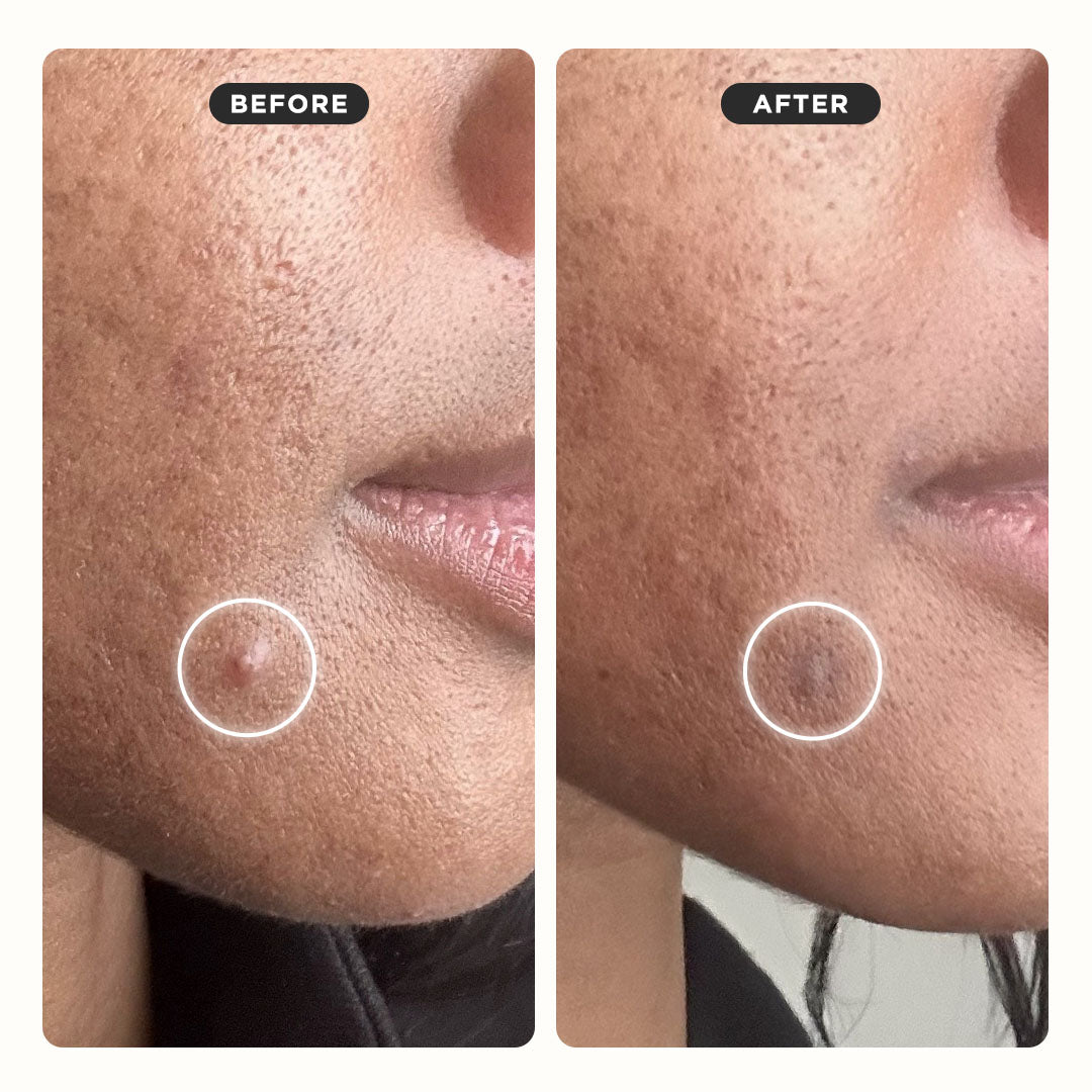 KILLA™ ACNE Extra Strength Microdart Patches