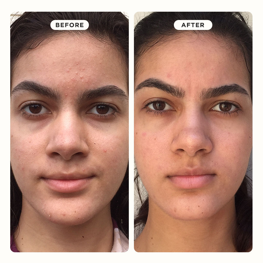 PORE VAC™